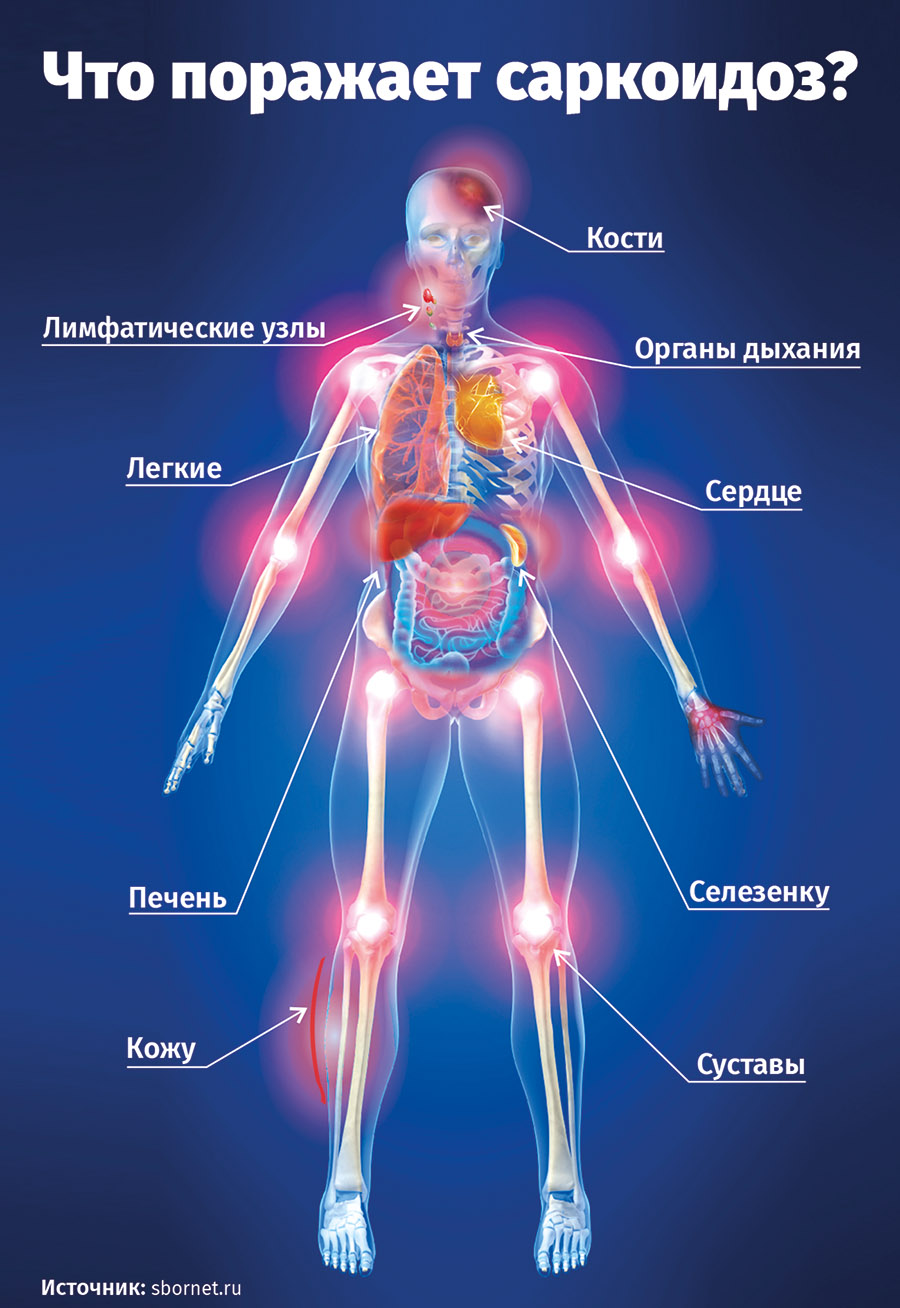 Саркоидоз легких симптомы заболевания. Саркоидоз внелегочные проявления. Симптомы при саркоидозе.