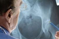 Хрупкая болезнь, или Как распознать остеопороз?