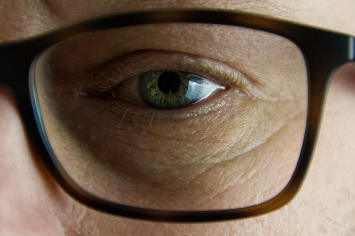 Вплоть до потери зрения – офтальмолог предупредила, какие осложнения может спровоцировать миопия