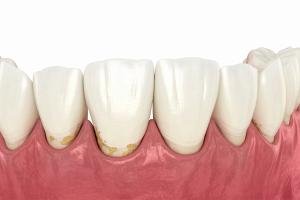 Стоматолог рассказала, что такое клиновидный дефект и чем он опасен 