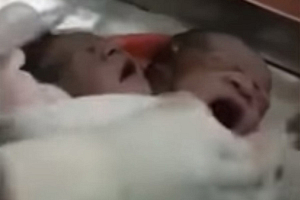 В Индии родился ребенок с двумя головами (видео)