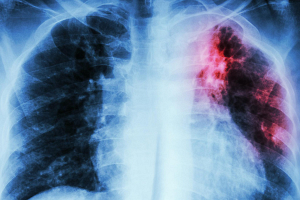  Каждые 20 секунд от туберкулеза умирает один человек